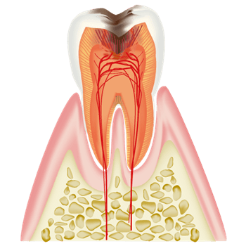 歯の神経にまで進行した虫歯