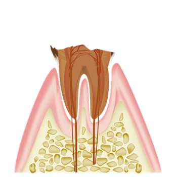 歯の根っこにまで進行した虫歯